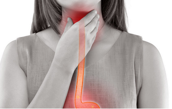 위식도역류질환 : 진단과 치료, 생활 속 회복 전략