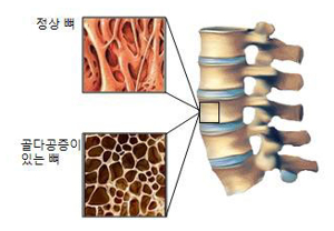 척추골절