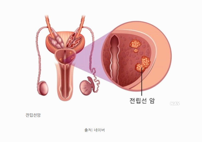 전립선암 초기 증상부터 진행 단계까지 꼭 알아야 할 체크리스트