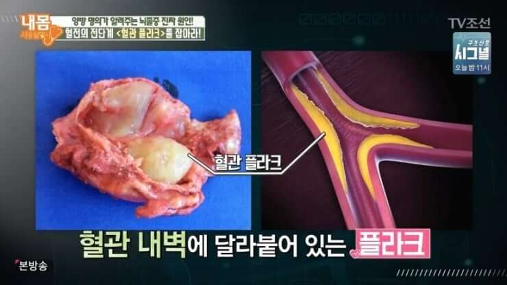 혈관 내벽에 달라붙어 있는 플라크