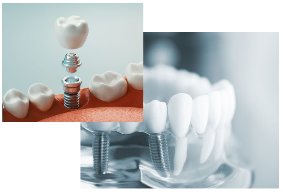 임플란트-교체-비용