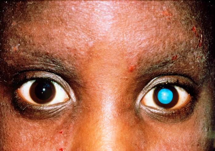 건강-백내장-환자