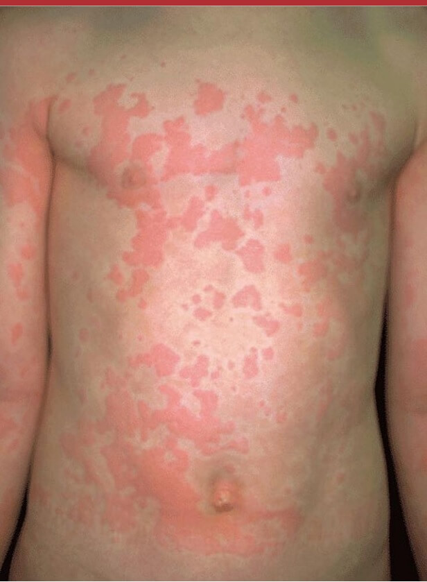 알레르기 반응 및 두두러기