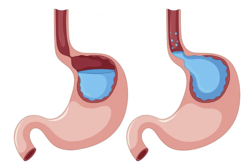 위산 역류 증상