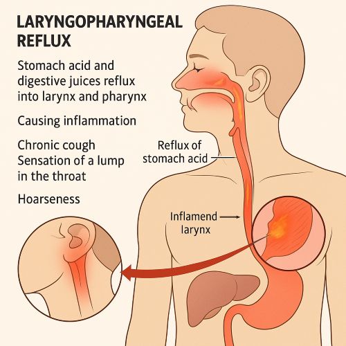 인후두역류질환