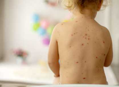 홍역, 요즘 유행하는 전염병, 홍역 총정리