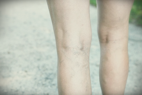하지정맥류 증상이 나타난 다리