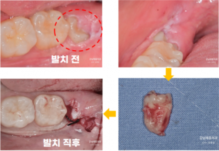 사랑니 발치