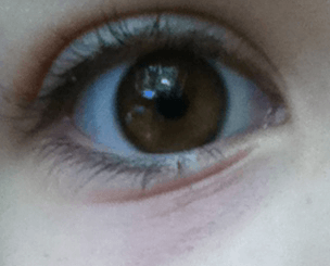 눈 밑에 보랏빛의 착색과 여러 겹의 주름이 있다.