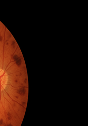 비문증 치료방법