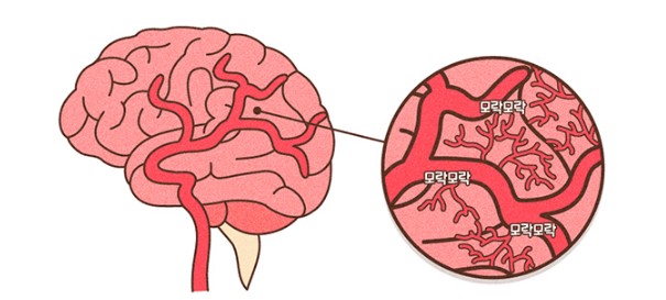 모야모야병