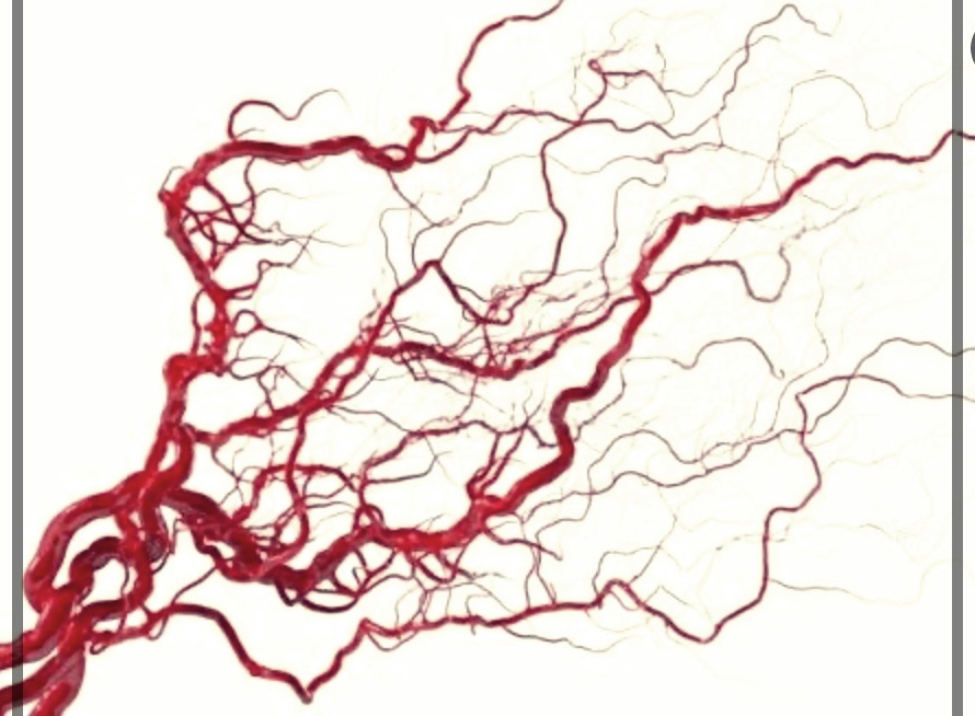 뇌 해면상 혈관종의 원인, 발생 이유 및 치료 방법에 대한 총정리.