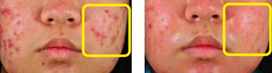 아클리프-4세대