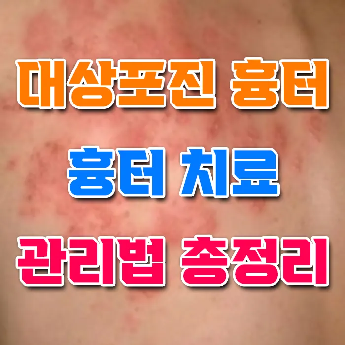 대상포진 흉터 치료 관리법 총정리