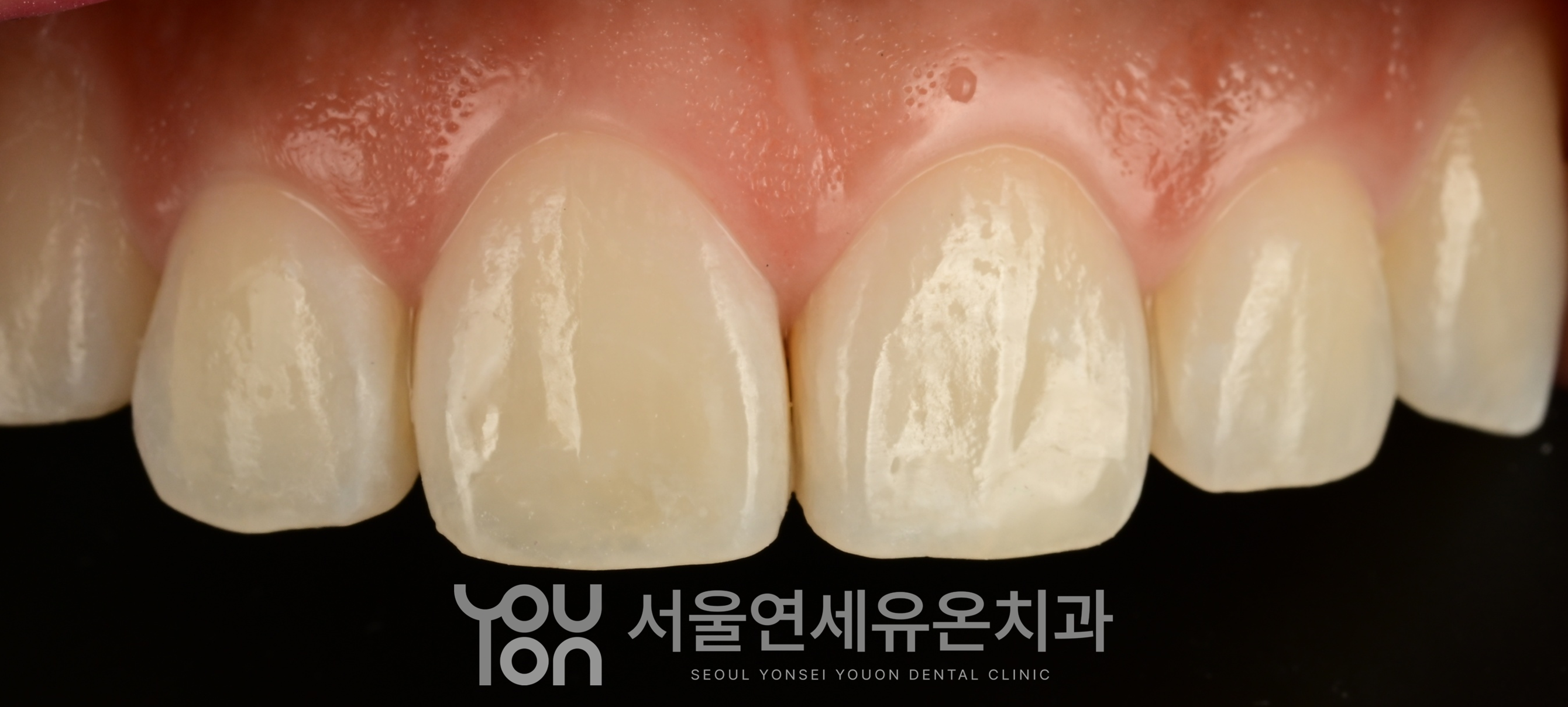 아이콘 레진 치료 전후 비교(후)