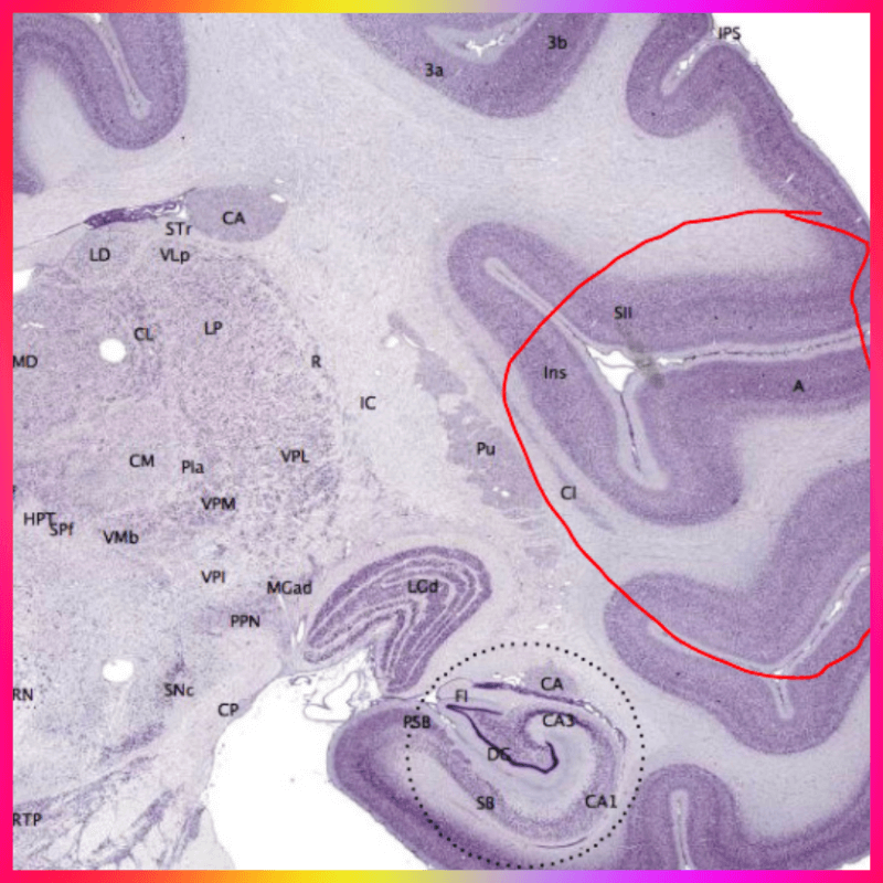 뇌경색 술 스트레스 사진