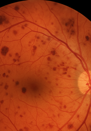 비문증 치료방법