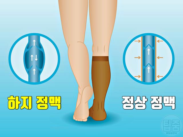 다리 양말자국 질환 코끼리다리 무다리 원인 하지정맥류