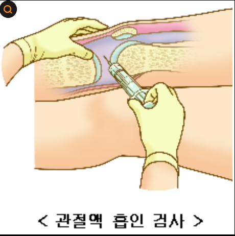 통풍 완전 가이드(검사법,자가테스트,좋은 음식,식단표)