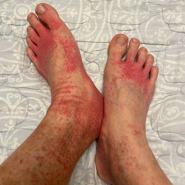 혈관염 증상 - 부종, 저림, 근육 및 관절 통증으로 걷기조차 힘든 상태