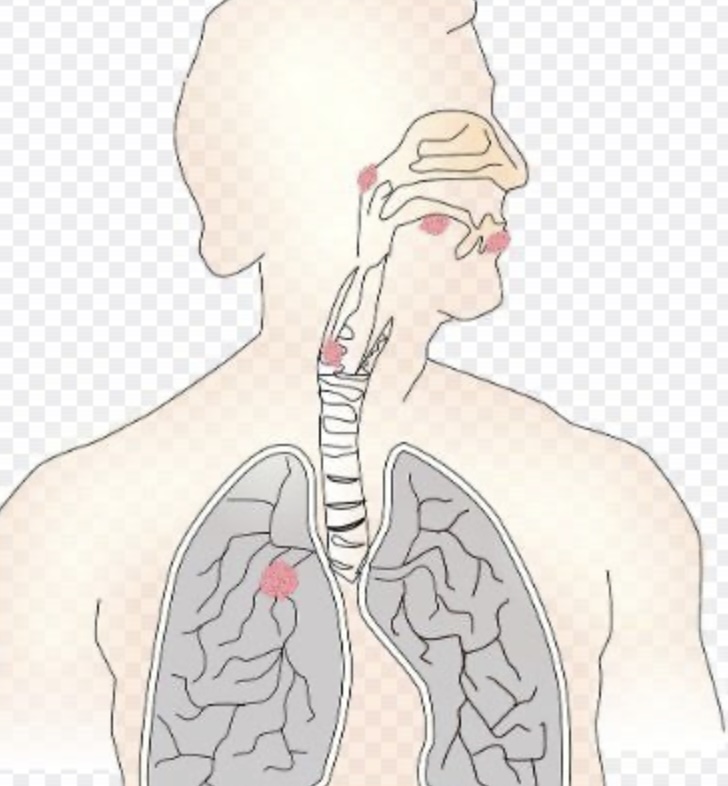 간유리음영 종류와 원인, 증상들