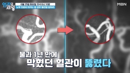 막힌혈관이뚫림