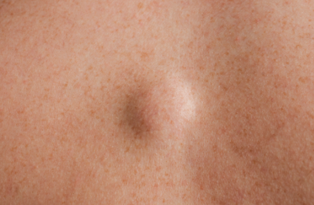 지방종 발생의 원인