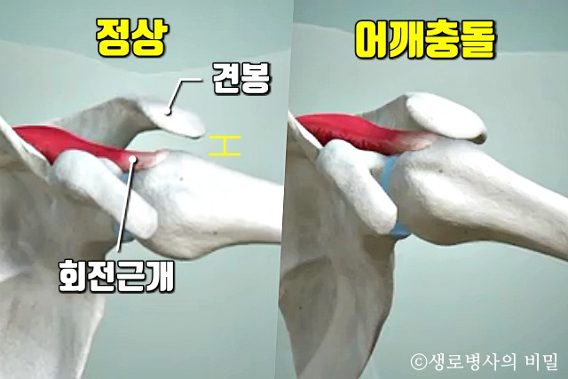 어깨통증 원인, 어깨충돌증후군 증상, 좋은 운동, 건강 팁줌 매일꿀정보