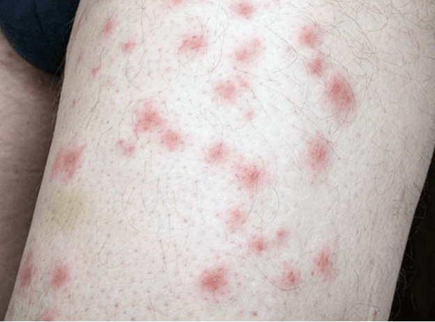 빈대 물린 자국 사진 및 증상