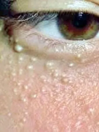 비립종 생기는 이유 비립종 없애는 방법 피부 관리법_19