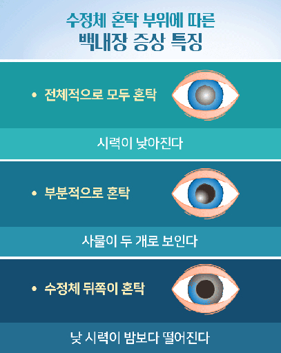 백내장 증상과 안과 병원 추천