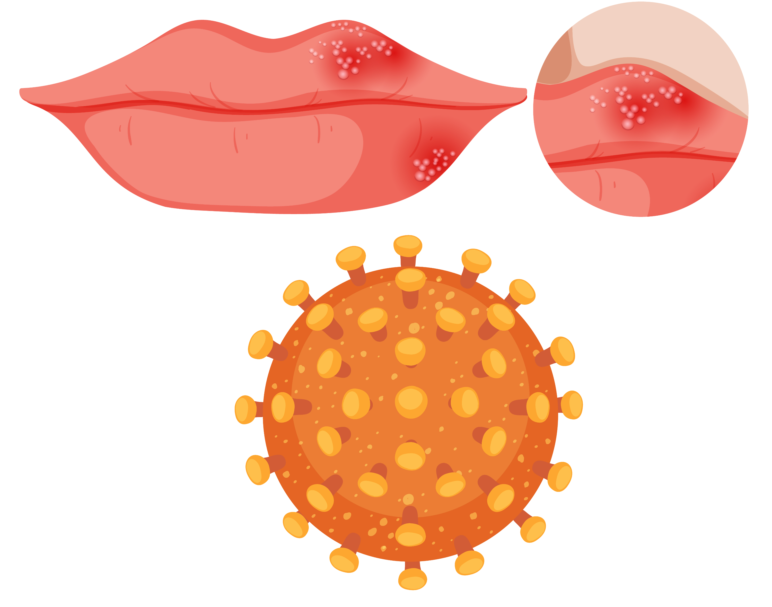 헤르페스(단순포진)