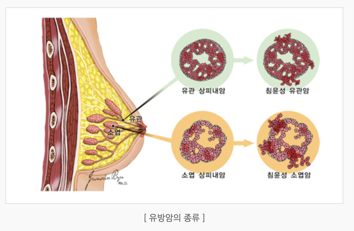 유방암의 종류