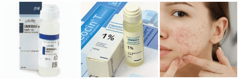 크레오신티, 여드름 사진