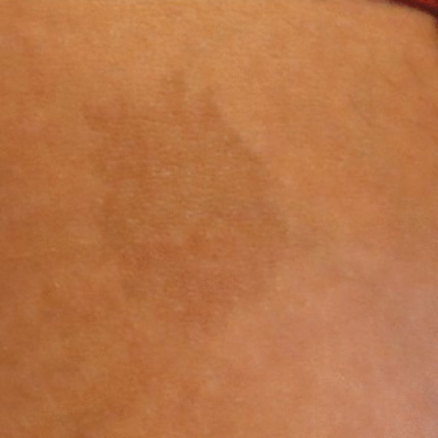 신경섬유종 초기 증상, 혹시 나도? 놓치면 안 되는 신호