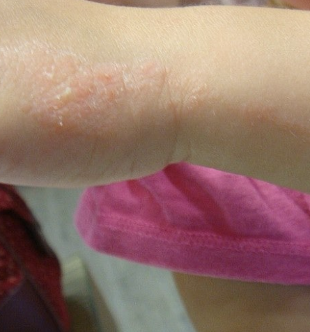 선상태선 증상 원인 레이저 얼굴 다리 연고 흉터