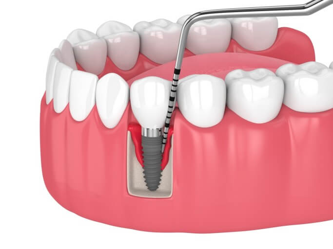 임플란트 보험 임플란트 가격 임플란트 비용 치아 보험 추천 치과 보험 추천 임플란트 치아 보험 치아 보험 적용 기과 보험 적용 치과 보험 임플란트 임플란트 치아