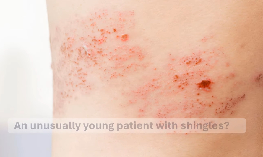 아시클로버 연고 효능