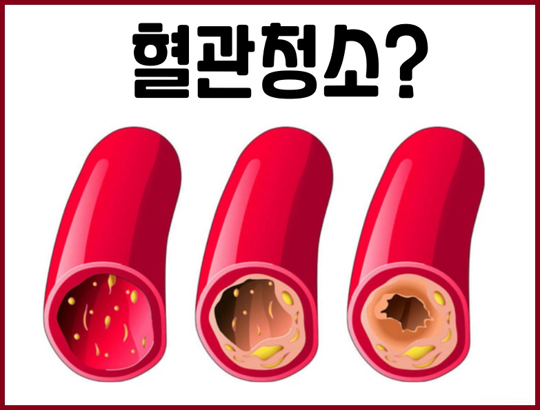혈관 건강 혈관 청소