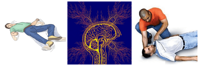 뇌전증 관련 사진 3개