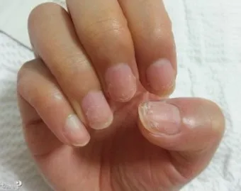 손톱이 갈라지는 이유 원인 증상 대처법_9