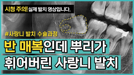 사랑니 발치 후 식사 가이드