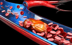 혈소판수치가 낮으면 일어나는 증상