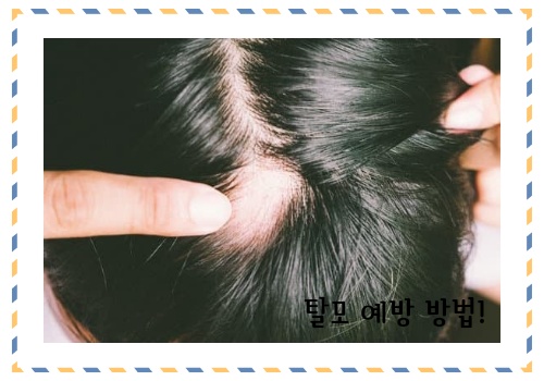 탈모 예방 방법 알아보고 예방