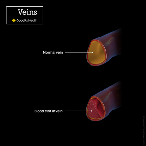 종아리 근육 뭉침