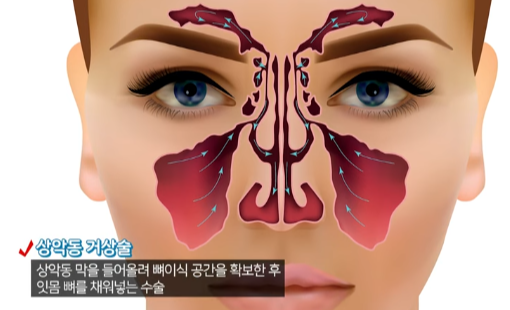 상악동거상술
