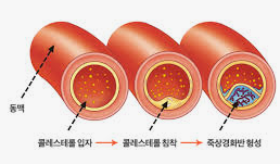 고지혈증 증상 12가지 총정리 섬네일