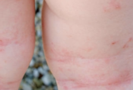 땀띠 가라앉히는 방법 10가지 총정리 섬네일