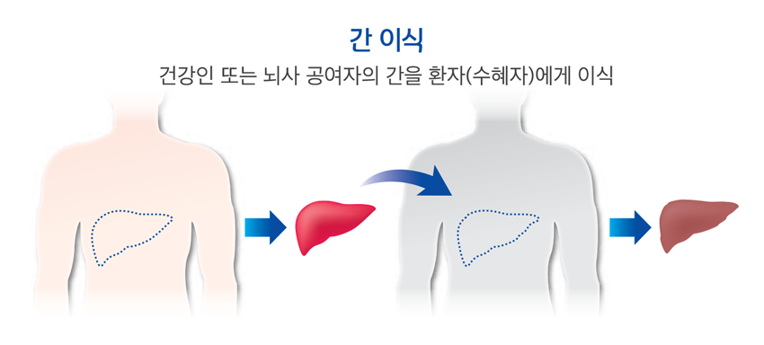 비만으로 간암까지? 술 안 마셔도 위험합니다