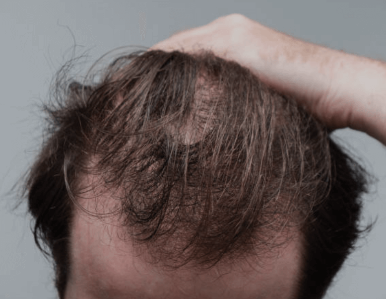 비 맞으면 탈모